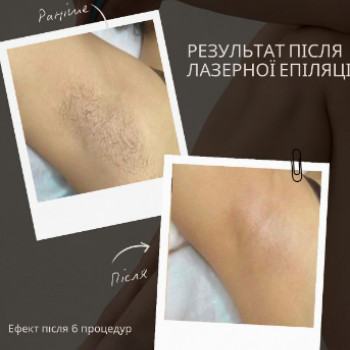 Фото из портфолио мастера Марина Решетникова (мастер лазерной эпиляции, Запорожье)