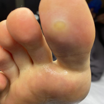 Видалення бородавки
ДО/ПІСЛЯ