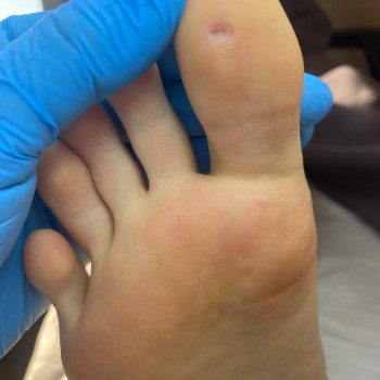 Видалення бородавки 
ДО/ПіІСЛЯ