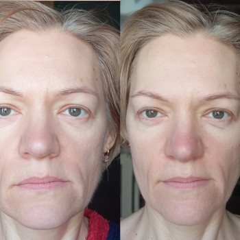 Масаж обличчя Джим . Перша процедура., фото - кінезітерапевт Наталія Денисова