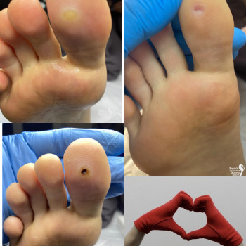 Видалення бородавок на стопі ДО/