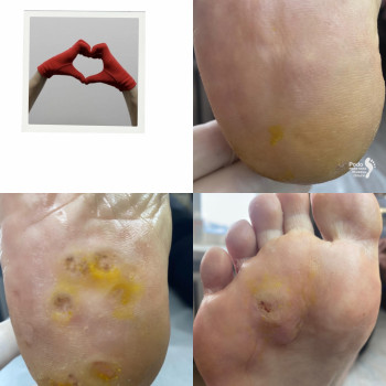 Видалення бородавок на стопі ПІСЛЯ/