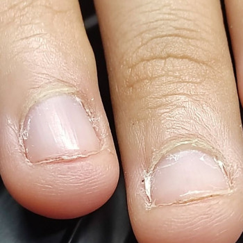 Часто в подростковом возрасте и даже у дошкольников дети грызут ногти — кто нервничает, кто по привычке. Из-за этого страдает ногтевая пластина, могут появляться заусенцы, трещинки и другие осложнения.

Важно заботиться не только о стопах и ногтях на нога