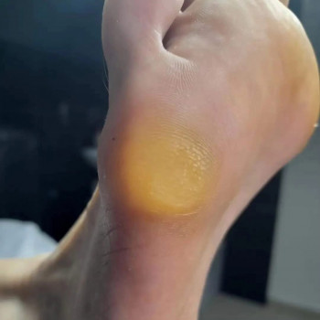 Видалення мозолелості на стопі ДО/ПІСЛЯ