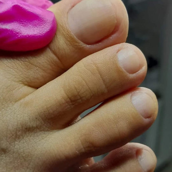 Медичний педикюр