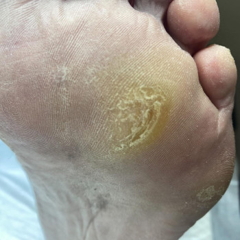 Діабетична стопа