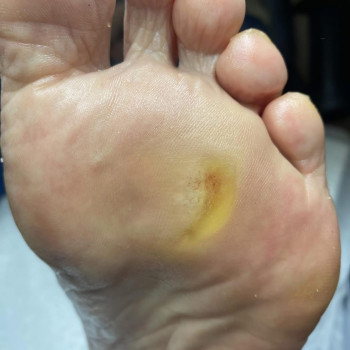 Діабетична стопа