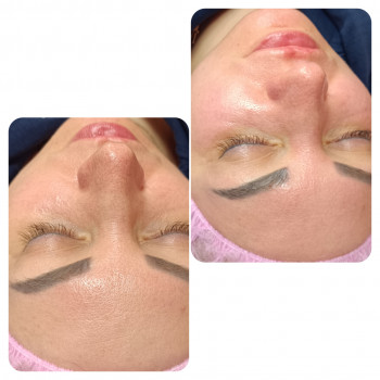 Комбінована чистка обличчя