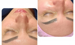 Комбінована чистка обличчя Косметолог-ін'єкціоніст Юлия Кропивницький