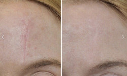 Безопераційна блефаропластика (метод сублімації холодною плазмою) Студия лазерной эпиляции Центр лазерної косметології Луцк