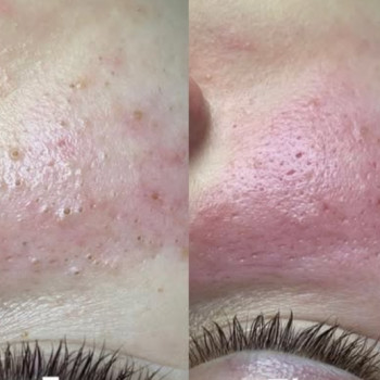 Фото з портфоліо косметолога Катерина Тарасенко (Запоріжжя)