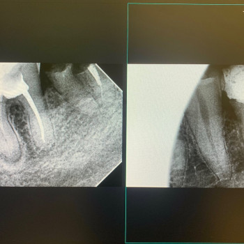Результат вторинного перелікування кореневих каналів за допомогою мікроскопа.