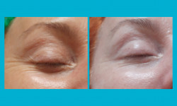 Мезопорация Косметолог-эстетист Ирина Валерьевна Одесса