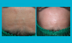 Мезотерапия Косметолог-эстетист Ирина Валерьевна Одесса