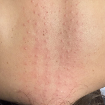   підготовка до мезотерапії волосистої частини голови