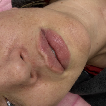 Контурна пластика губ