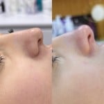 Без операційна ринопластика гарна ціна Косметолог-инъекционист Любов Запорожье