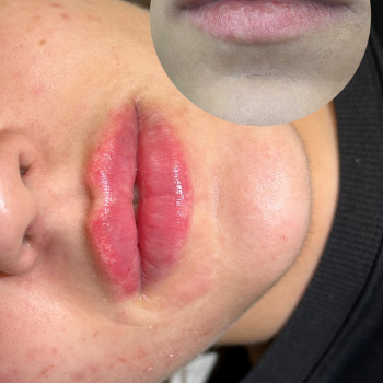 Контурна пластика губ
                    Косметолог  Київ