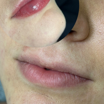 Контурна пластика губ
                    Косметолог  Київ