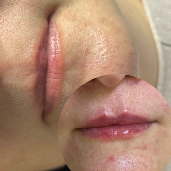 Контурна пластика губ
                    Косметолог  Київ