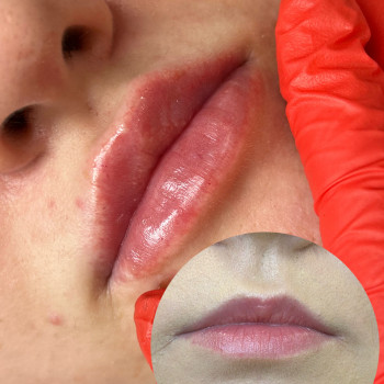 Контурна пластика губ
                    Косметолог  Київ