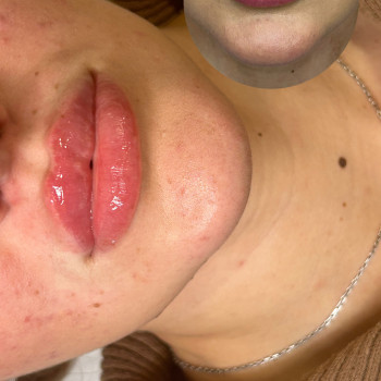 Контурна пластика губ
                    Косметолог  Київ