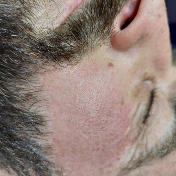 Электроэпиляция
                    Мастер депиляции Елена Арциз