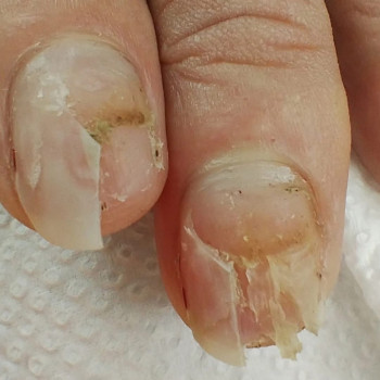 Відновлення нігтів
ДО/ПІСЛЯ