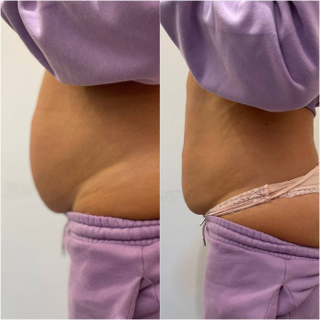 Дві інʼєкції біопатиду      