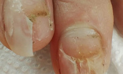 Восстановление ногтевых пластин Подолог Ольга Чернигов