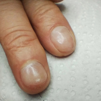 Після//відновлення