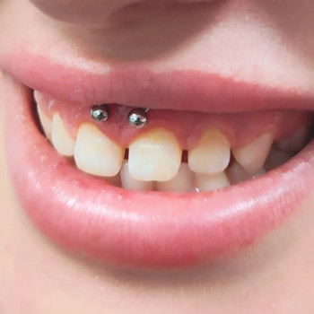 Пірсинг смайл
   
 