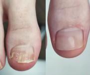 Протезування нігтя Подолог Оксана Чернигов