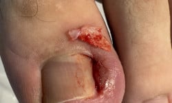 Запалення, нагноєння, грануляція, припухлість шкіри Подолог Ольга Черная Запорожье