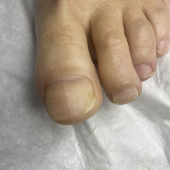 Стан нігтьової пластини після подологічної обробки:
Нігтьова пластина I пальця стопи очищена від ві...