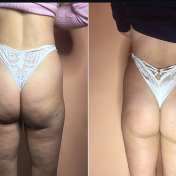 Антицеллюлитный массаж, фото - массажист Владимир Миклей