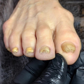 Подологічна зачистка нігтів при грибковому ураженні До/