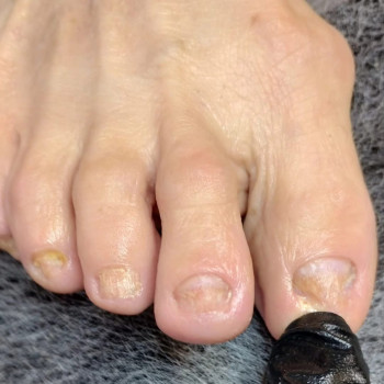 Подологічна зачистка нігтів при грибковому ураженні /Після