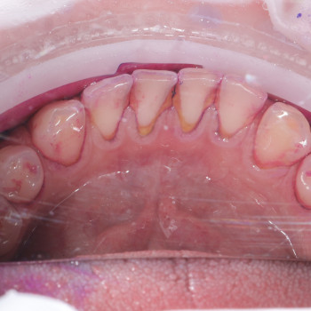 Фарбування нальоту