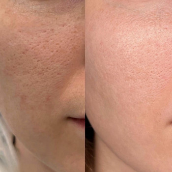 Мікронідлінг Dr.Pen
                    Косметологический центр Doskonala Киев