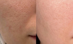 Мікронідлінг Dr.Pen Косметологический центр Doskonala Киев