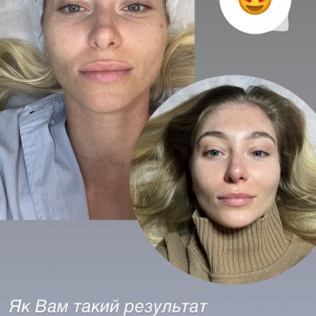 Мікронідлінг Dr.Pen
                    Косметологический центр Doskonala Киев