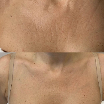 Мікронідлінг Dr.Pen
                    Косметологический центр Doskonala Киев