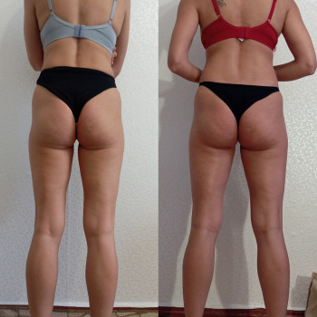 Медовый антицеллюлитный массаж
                    Массажист Анна Одесса