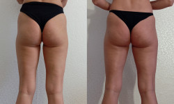 Медовый антицеллюлитный массаж Масажист Анна Одеса