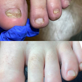 Відновлення грибкових нігтів 15-ти річної давності