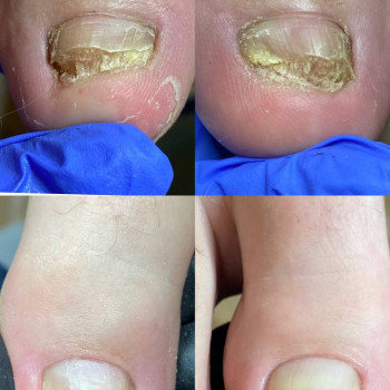 Відновлення грибкових нігтів з давнім ураженням