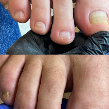 Відновлення нігтів після тривалого ураження грибком (оніхомікоз)