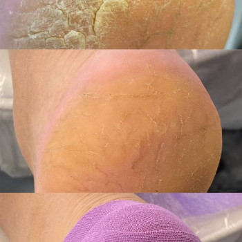 Обробка та подальше лікування тріщин з накладання окклюзивної пов'язки