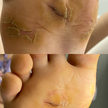 Обробка кератодермії у дитини (спільна робота з дерматологом)